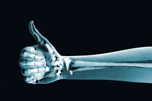 image of an arm and hand x-ray, with the hand giving a thumb's up